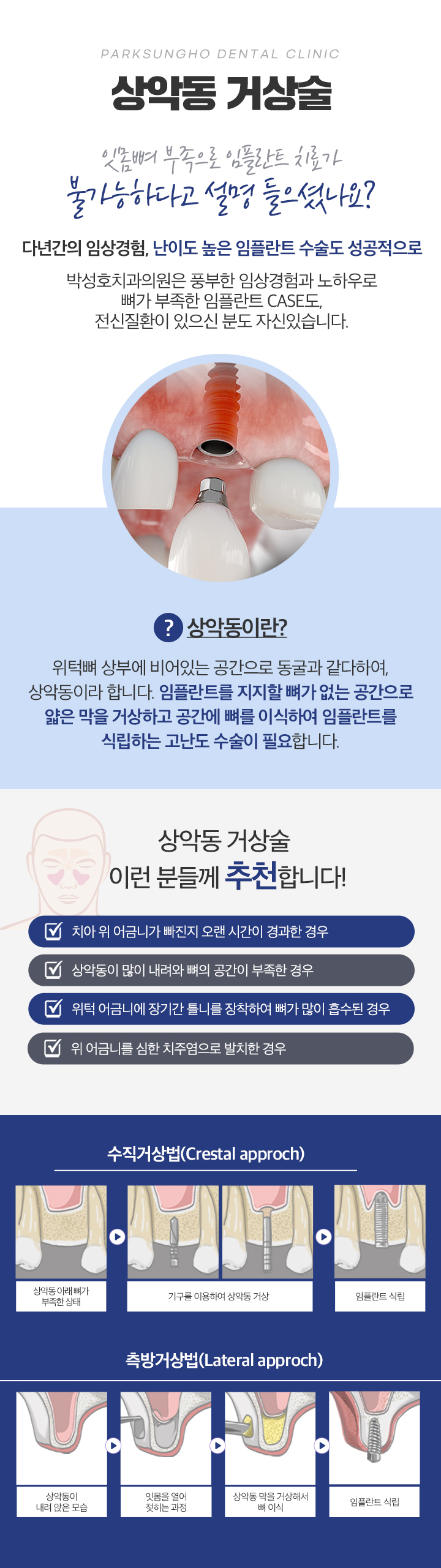 상악동 거상술