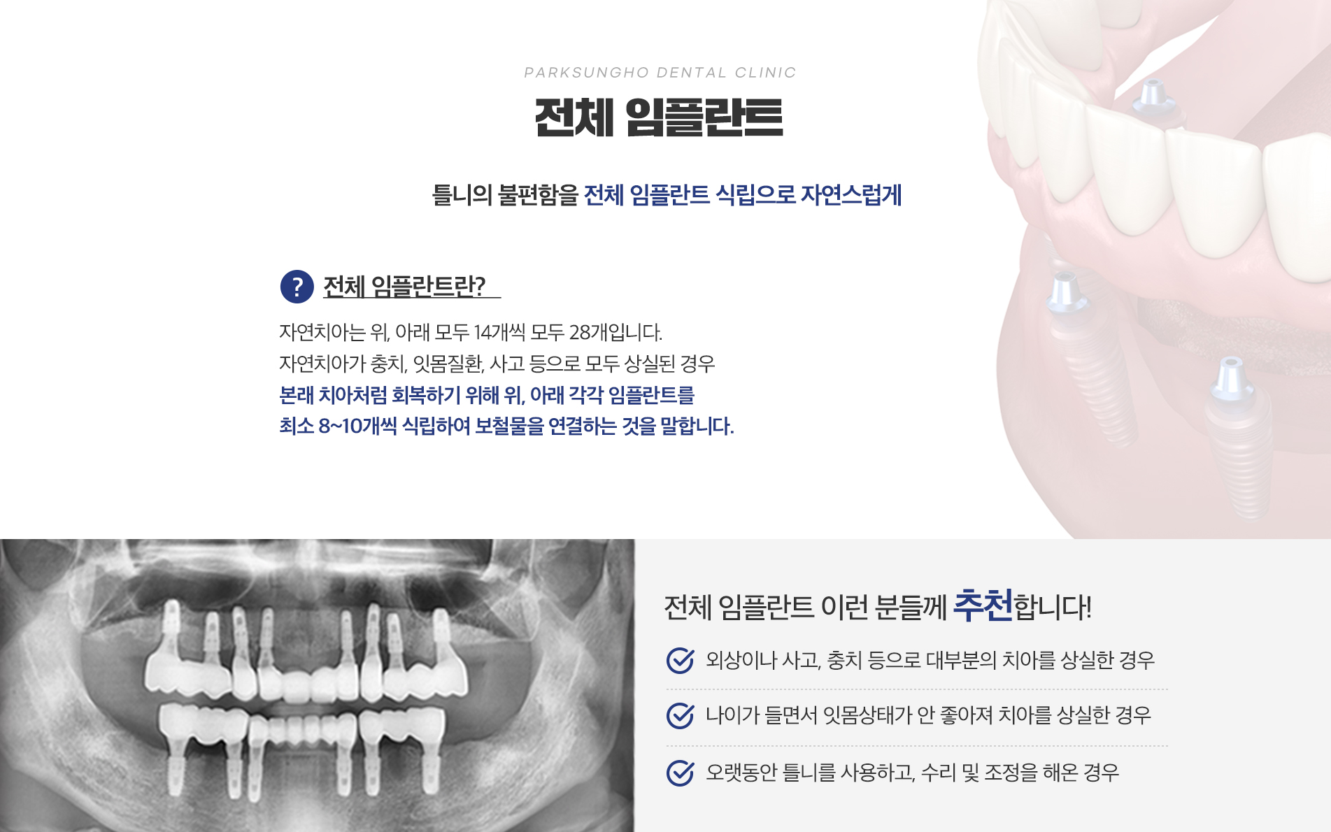 전체 임플란트