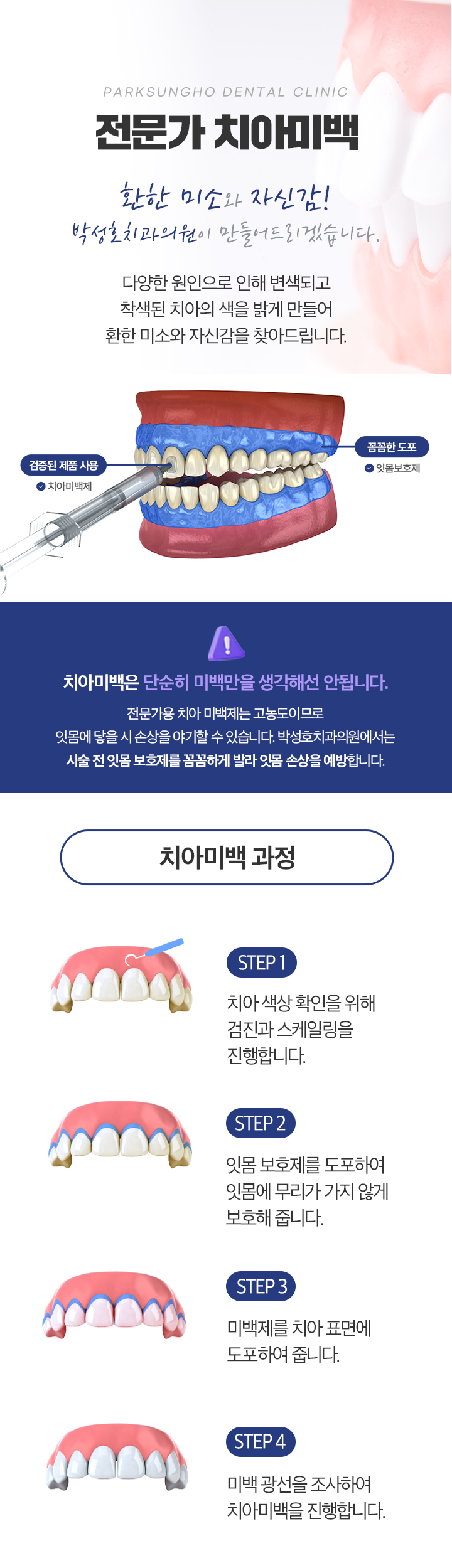 전문가 치아미백