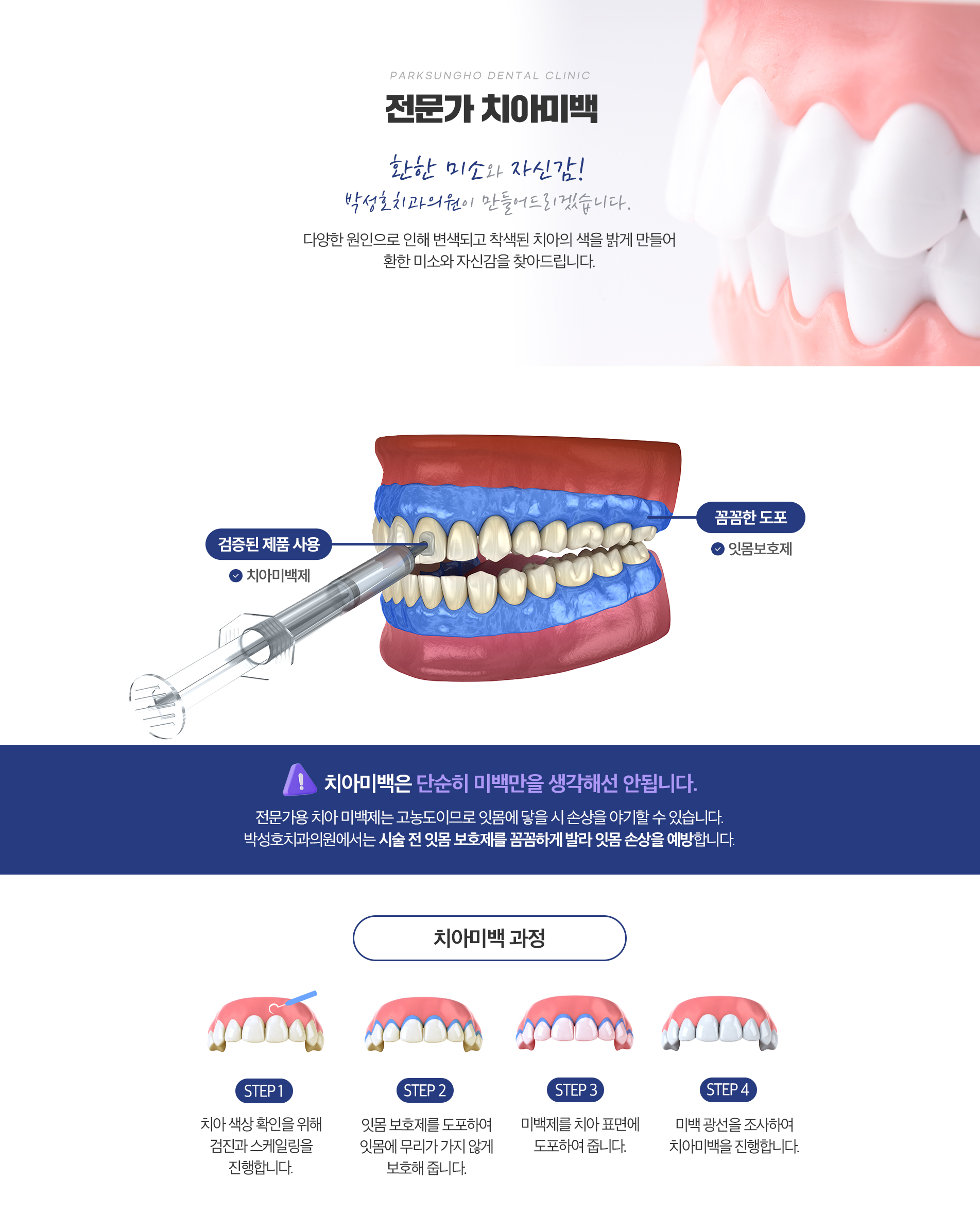 전문가 치아미백