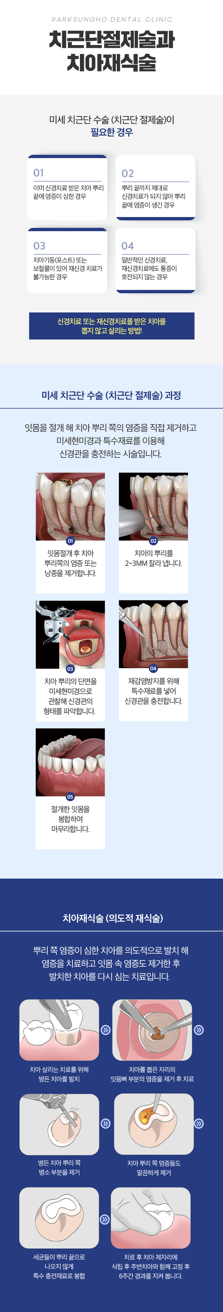 치근단재식술과 치아재식술