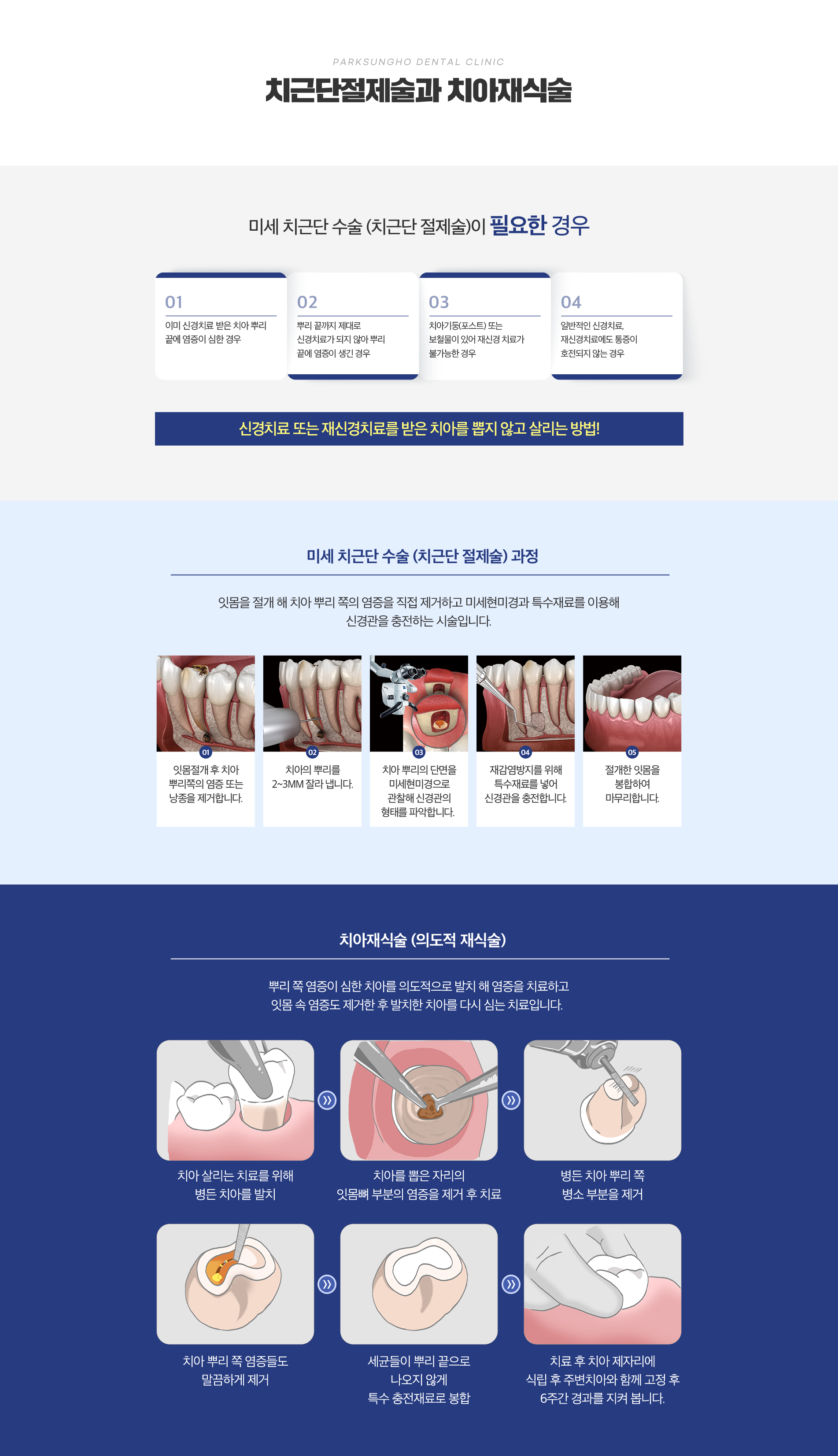 치근단절제술과 치아재식술